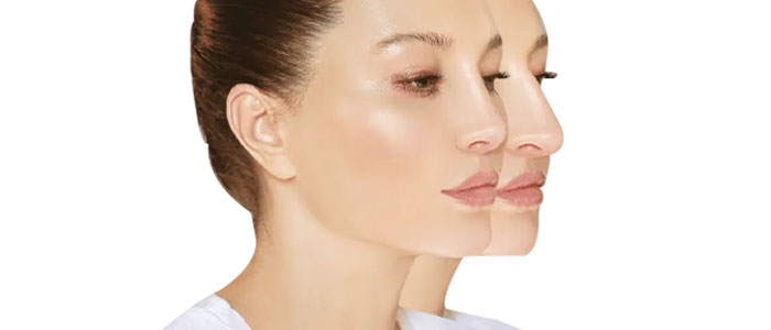 Combien coute une rhinoplastie ?