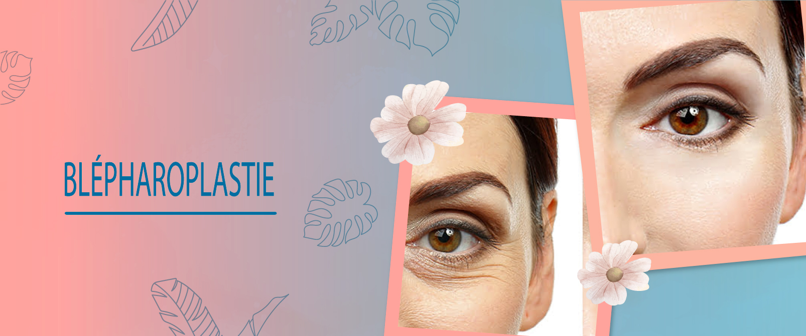 Blépharoplastie en Tunisie