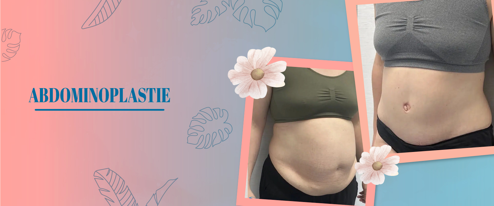 abdominoplastie tunisie