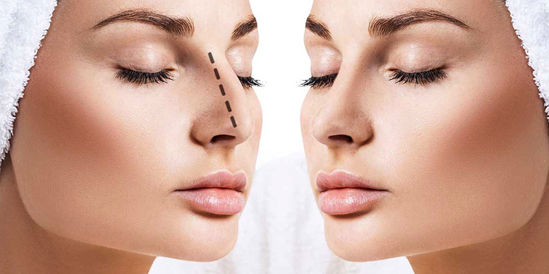 résultats naturels rhinoplastie Tunisie